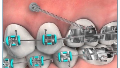 Cắm vít niềng răng (Minivis) là gì? Khi nào cần tiến hành cắm Minivis 