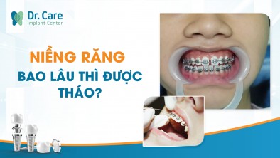 Niềng răng lâu không? 9 mẹo giúp rút ngắn quá trình niềng răng