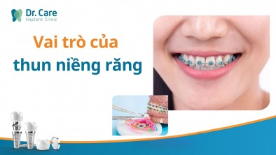 Vai trò của thun niềng răng