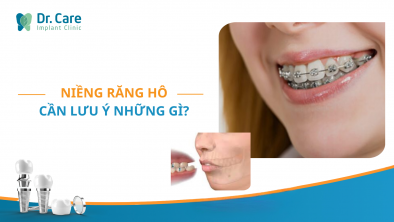 Niềng răng hô cần lưu ý những gì?