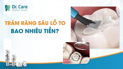 Trám răng sâu lỗ to bao nhiêu tiền?