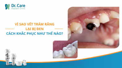 [CHI TIẾT] - Vì sao vết trám răng lại bị đen ? Cách khắc phục như thế nào?