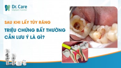 Sau khi lấy tủy răng, triệu chứng bất thường cần lưu ý là gì?