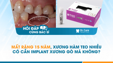 [Hỏi đáp bác sĩ] - Mất răng 15 năm, xương hàm teo nhiều có cần Implant xương gò má không?