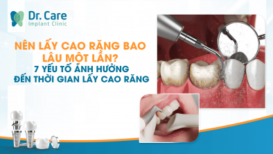 Nên Lấy Cao Răng Bao Lâu Một Lần? 7 Yếu Tố Ảnh Hưởng Đến Thời Gian Lấy Cao Răng