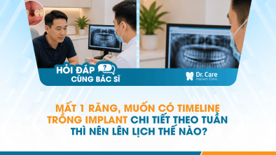 [Hỏi đáp bác sĩ] - Mất 1 răng, muốn có timeline trồng Implant chi tiết theo tuần thì nên lên lịch thế nào?