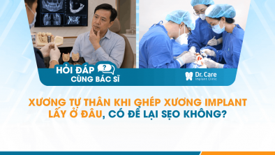  [Hỏi đáp bác sĩ] - Xương tự thân khi ghép xương Implant lấy ở đâu, có để lại sẹo không?