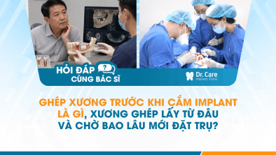 [Hỏi đáp bác sĩ] - Ghép xương trước khi cắm Implant là gì, xương ghép lấy từ đâu và chờ bao lâu mới đặt trụ?