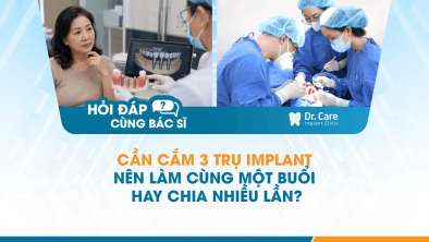  [Hỏi đáp bác sĩ] - Cần cắm 3 trụ Implant nên làm cùng một buổi hay chia nhiều lần?