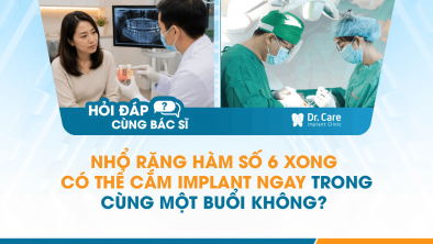 [Hỏi đáp bác sĩ] - Nhổ răng hàm số 6 xong có thể cắm Implant ngay trong cùng một buổi không?