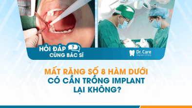 [Hỏi đáp bác sĩ] - Mất răng số 8 hàm dưới có cần trồng Implant lại không?