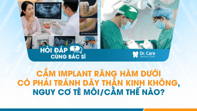 [Hỏi đáp bác sĩ] - Cắm Implant răng hàm dưới có phải tránh dây thần kinh không, nguy cơ tê môi/cằm thế nào?