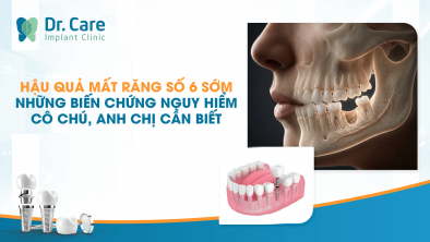 Hậu Quả Mất Răng Số 6 Sớm: Những Biến Chứng Nguy Hiểm Cô Chú, Anh Chị Cần Biết