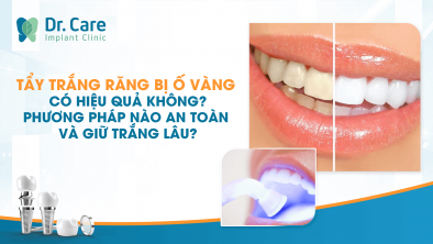 Tẩy trắng răng bị ố vàng có hiệu quả không? Phương pháp nào an toàn và giữ trắng lâu?