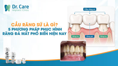 Cầu răng sứ là gì? 5 phương pháp phục hình răng đã mất phổ biến hiện nay