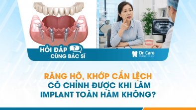 HỎI ĐÁP BÁC SĨ]: Răng hô, khớp cắn lệch có chỉnh được khi làm Implant toàn hàm không?