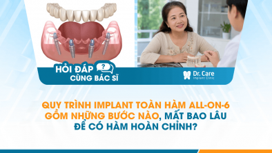 [HỎI ĐÁP BÁC SĨ]: Quy trình Implant toàn hàm All-on-6 gồm những bước nào, mất bao lâu để có hàm hoàn chỉnh?