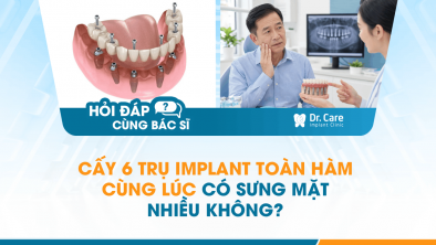 [HỎI ĐÁP BÁC SĨ]: CẤY 6 TRỤ IMPLANT TOÀN HÀM CÙNG LÚC CÓ SƯNG MẶT NHIỀU KHÔNG?