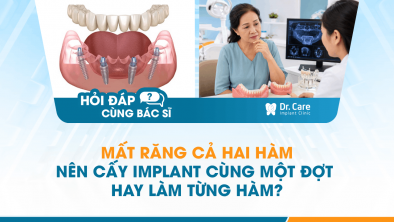 [HỎI ĐÁP BÁC SĨ]: MẤT RĂNG CẢ HAI HÀM NÊN CẤY IMPLANT CÙNG MỘT ĐỢT HAY LÀM TỪNG HÀM?