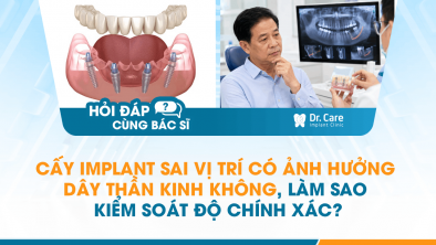 [HỎI ĐÁP BÁC SĨ]: Cấy Implant sai vị trí có ảnh hưởng dây thần kinh không, làm sao kiểm soát độ chính xác?