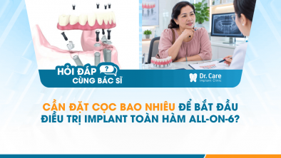 [HỎI ĐÁP BÁC SĨ]: Cần đặt cọc bao nhiêu để bắt đầu điều trị Implant toàn hàm All-on-6?