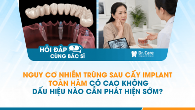 [HỎI ĐÁP BÁC SĨ]: Nguy cơ nhiễm trùng sau cấy Implant toàn hàm có cao không, dấu hiệu nào cần phát hiện sớm?