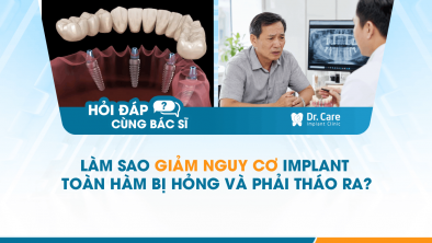 [HỎI ĐÁP BÁC SĨ]: Làm sao giảm nguy cơ Implant toàn hàm bị hỏng và phải tháo ra?