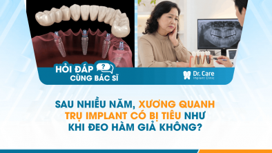 [HỎI ĐÁP BÁC SĨ]: Sau nhiều năm, xương quanh trụ Implant có bị tiêu như khi đeo hàm giả không?