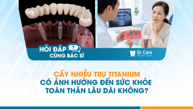 [HỎI ĐÁP BÁC SĨ]: Cấy nhiều trụ titanium có ảnh hưởng đến sức khỏe toàn thân lâu dài không?