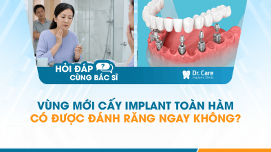 [HỎI ĐÁP BÁC SĨ]: Vùng mới cấy Implant toàn hàm có được đánh răng ngay không?