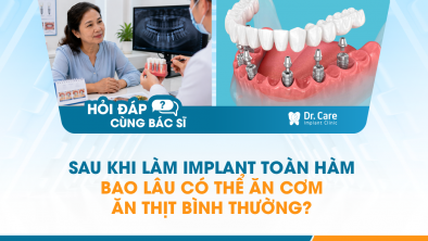[HỎI ĐÁP BÁC SĨ]: Sau khi làm Implant toàn hàm bao lâu có thể ăn cơm, ăn thịt bình thường?