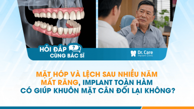 [HỎI ĐÁP BÁC SĨ]: Mặt hóp và lệch sau nhiều năm mất răng, Implant toàn hàm có giúp khuôn mặt cân đối lại không?