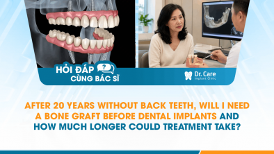 [HỎI ĐÁP BÁC SĨ]: After 20 Years Without Back Teeth, Will I Need a Bone Graft Before Dental Implants—and How Much Longer Could Treatment Take?