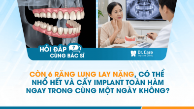 [HỎI ĐÁP BÁC SĨ]: Còn 6 răng lung lay nặng, có thể nhổ hết và cấy Implant toàn hàm ngay trong cùng một ngày không?