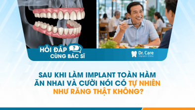 [HỎI ĐÁP BÁC SĨ]: Sau khi làm Implant toàn hàm, ăn nhai và cười nói có tự nhiên như răng thật không?