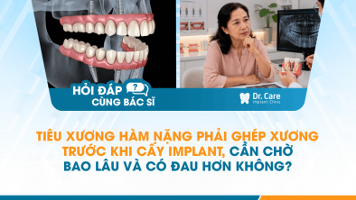 Tiêu đề: [HỎI ĐÁP BÁC SĨ]: Tiêu xương hàm nặng phải ghép xương trước khi cấy Implant, cần chờ bao lâu và có đau hơn không?