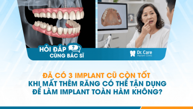 [HỎI ĐÁP BÁC SĨ]: Đã có 3 Implant cũ còn tốt, khi mất thêm răng có thể tận dụng để làm Implant toàn hàm không?