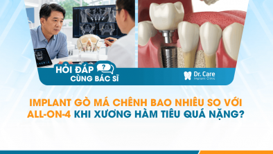 [HỎI ĐÁP BÁC SĨ]: Implant gò má chênh bao nhiêu so với All-on-4 khi xương hàm tiêu quá nặng?