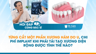 [HỎI ĐÁP BÁC SĨ]: Từng cắt một phần xương hàm do u, chi phí Implant khi phải tái tạo xương diện rộng được tính thế nào?