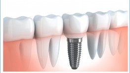 So sánh trồng răng Implant với phương pháp cầu răng sứ và hàm tháo lắp