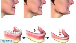 Có nên trồng răng giả không khi bị mất răng?