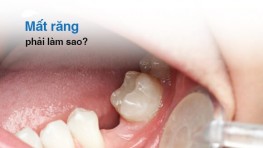 Mất răng vĩnh viễn nhưng không trồng răng có sao không?