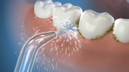 Nguyên nhân gây mảng bám trên răng và cách điều trị hiệu quả