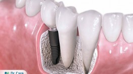 Kinh nghiệm trồng răng Implant (cấy ghép Implant) bạn cần biết