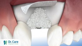 Phẫu thuật ghép xương trong trồng răng Implant