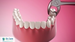 Trong nha khoa chữa sâu răng như thế nào?