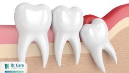 Răng khôn mọc ở vị trí nào và là răng số mấy?