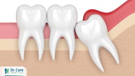 Sưng răng khôn có mủ: Nguyên nhân và cách khắc phục