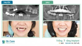 Mất răng cô sụt mất 5 ký - Trồng răng Implant cô tăng hẳn 2 ký chỉ trong vài tháng