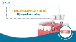 Trồng răng implant giá rẻ - Hậu quả khôn lường